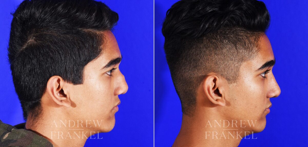 Revision Rhinoplasty before and after photos in Beverly Hills, CA, Patient 12553