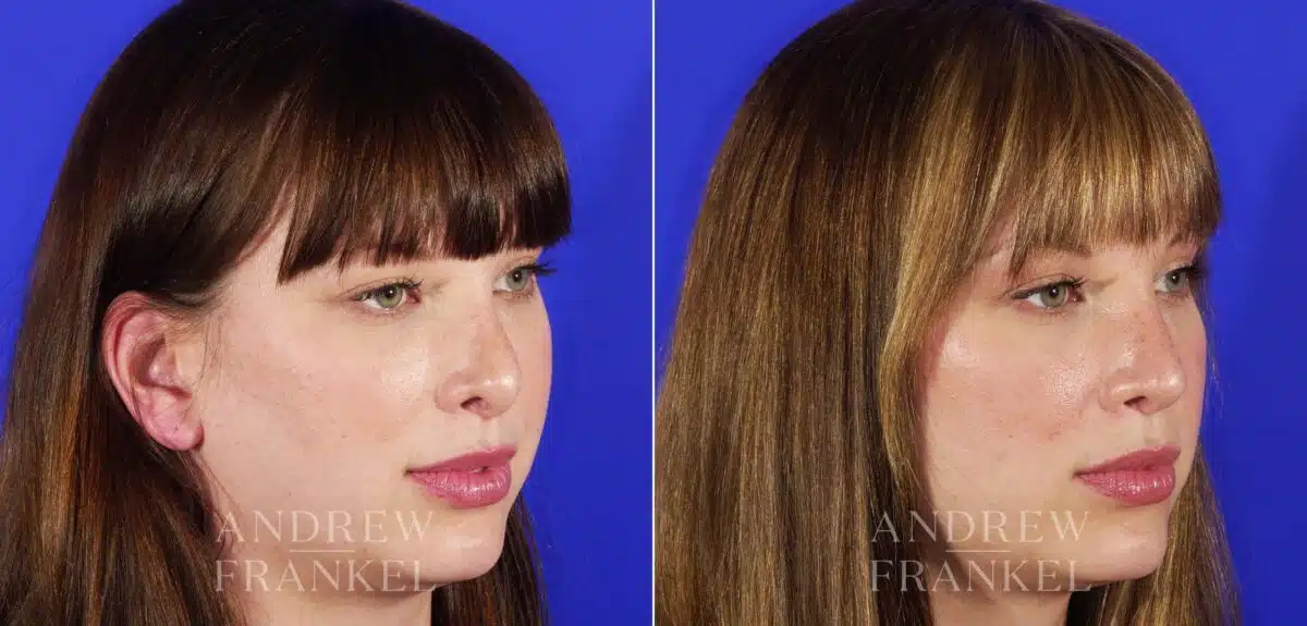 Revision Rhinoplasty before and after photos in Beverly Hills, CA, Patient 12611