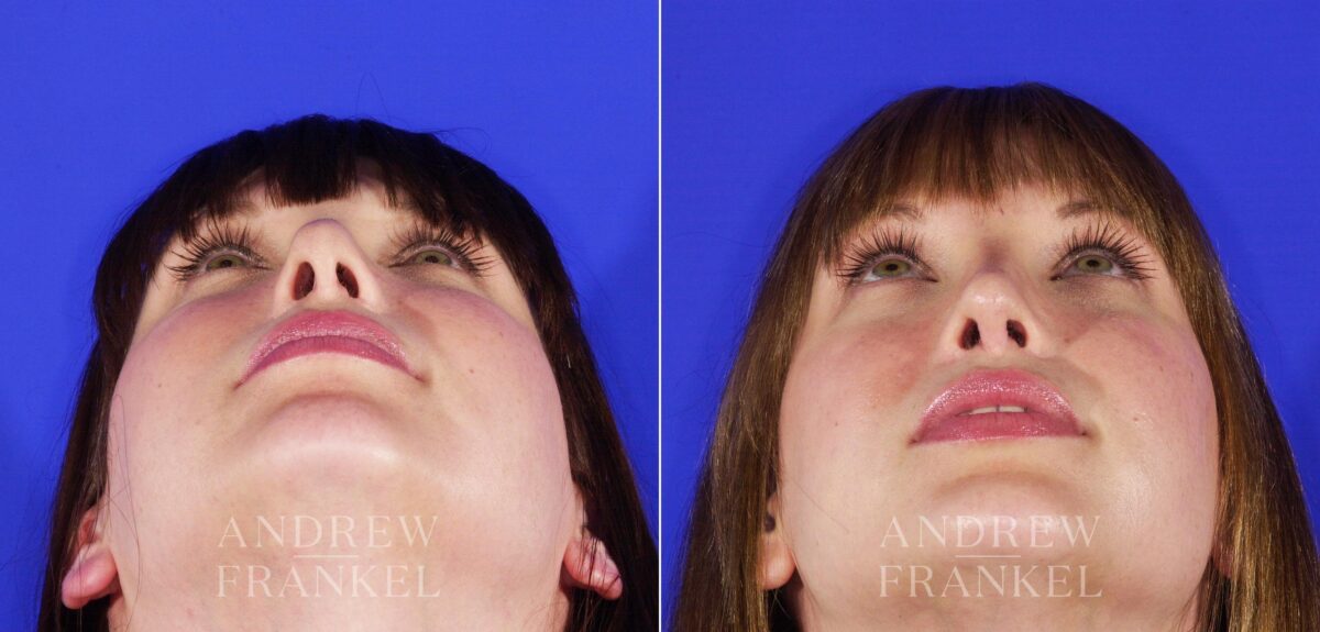Revision Rhinoplasty before and after photos in Beverly Hills, CA, Patient 12611