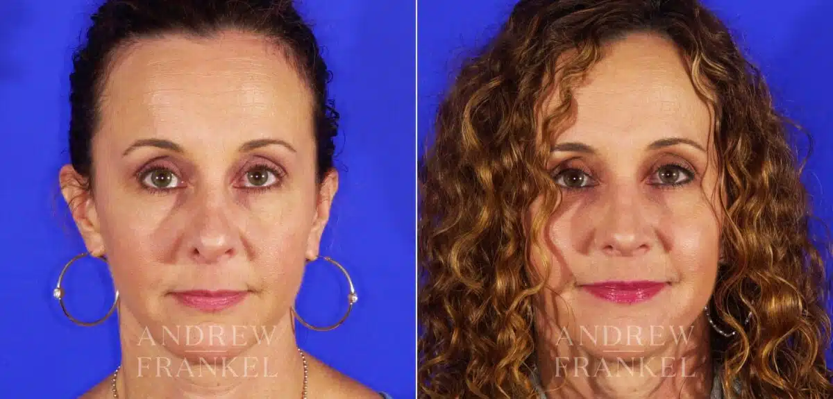 Revision Rhinoplasty before and after photos in Beverly Hills, CA, Patient 12677