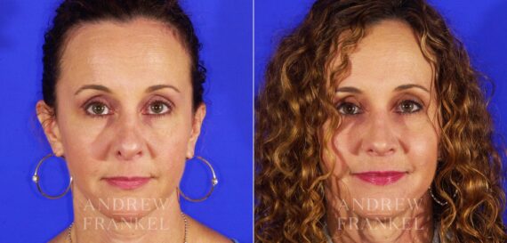 Revision Rhinoplasty before and after photos in Beverly Hills, CA, Patient 12677