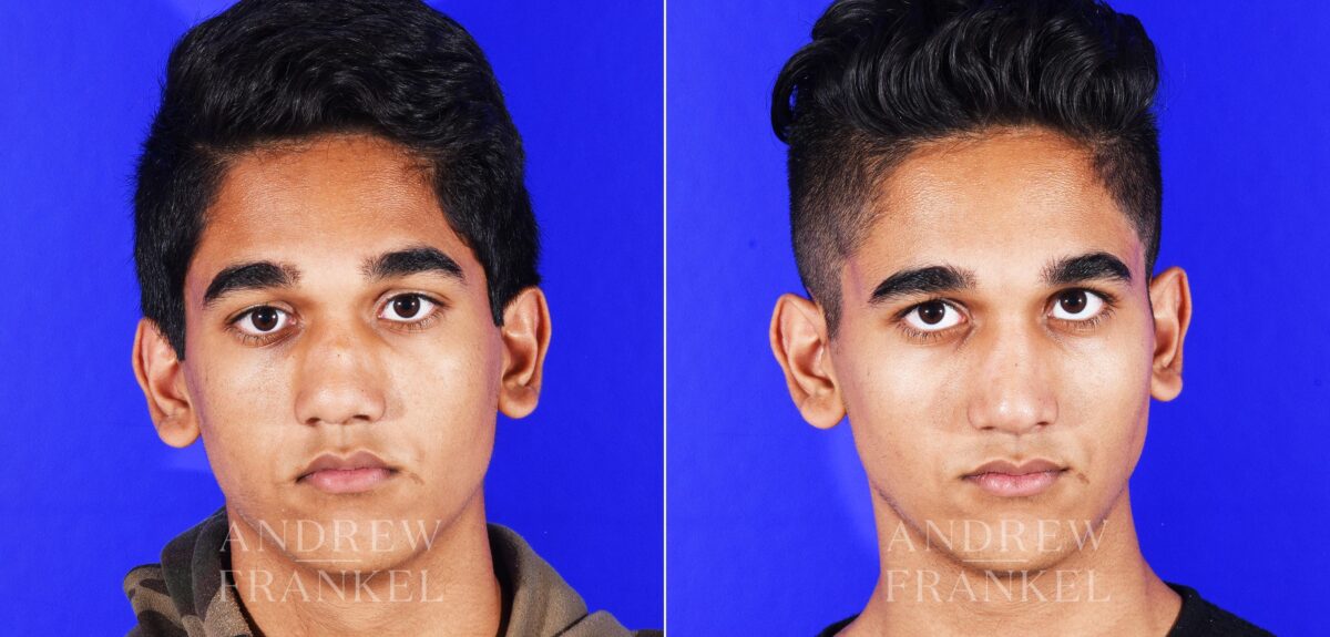 Revision Rhinoplasty before and after photos in Beverly Hills, CA, Patient 12553
