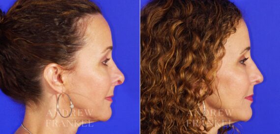 Revision Rhinoplasty before and after photos in Beverly Hills, CA, Patient 12677