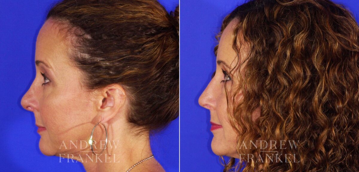 Revision Rhinoplasty before and after photos in Beverly Hills, CA, Patient 12677