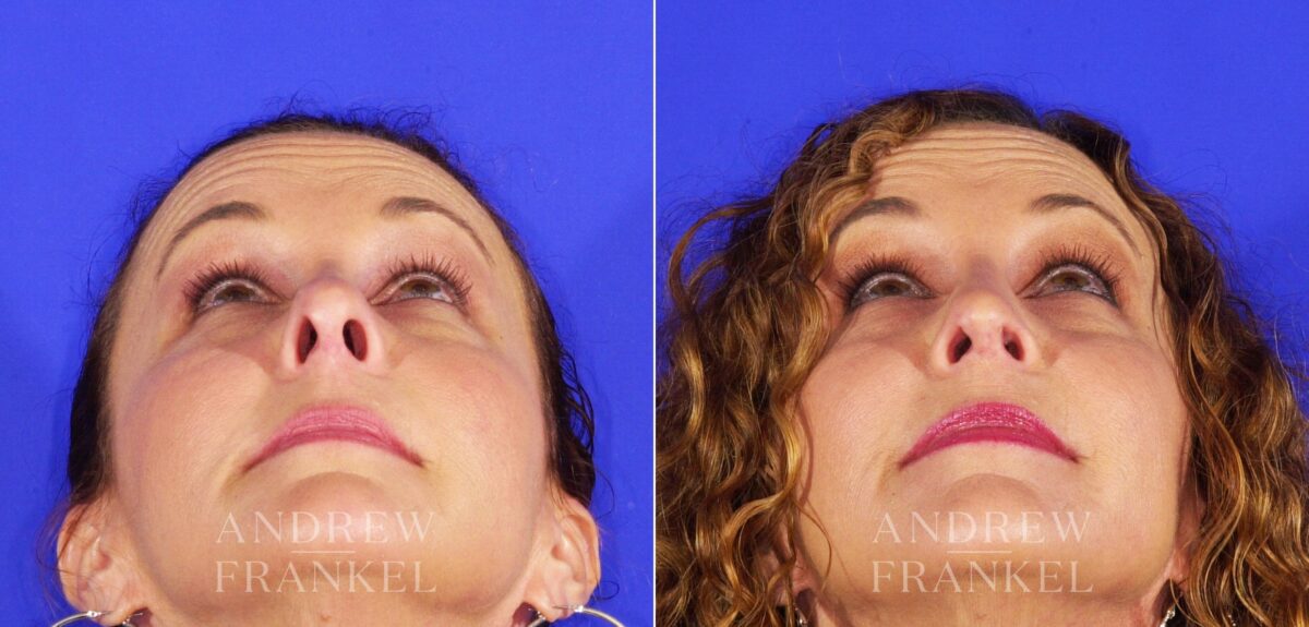 Revision Rhinoplasty before and after photos in Beverly Hills, CA, Patient 12677