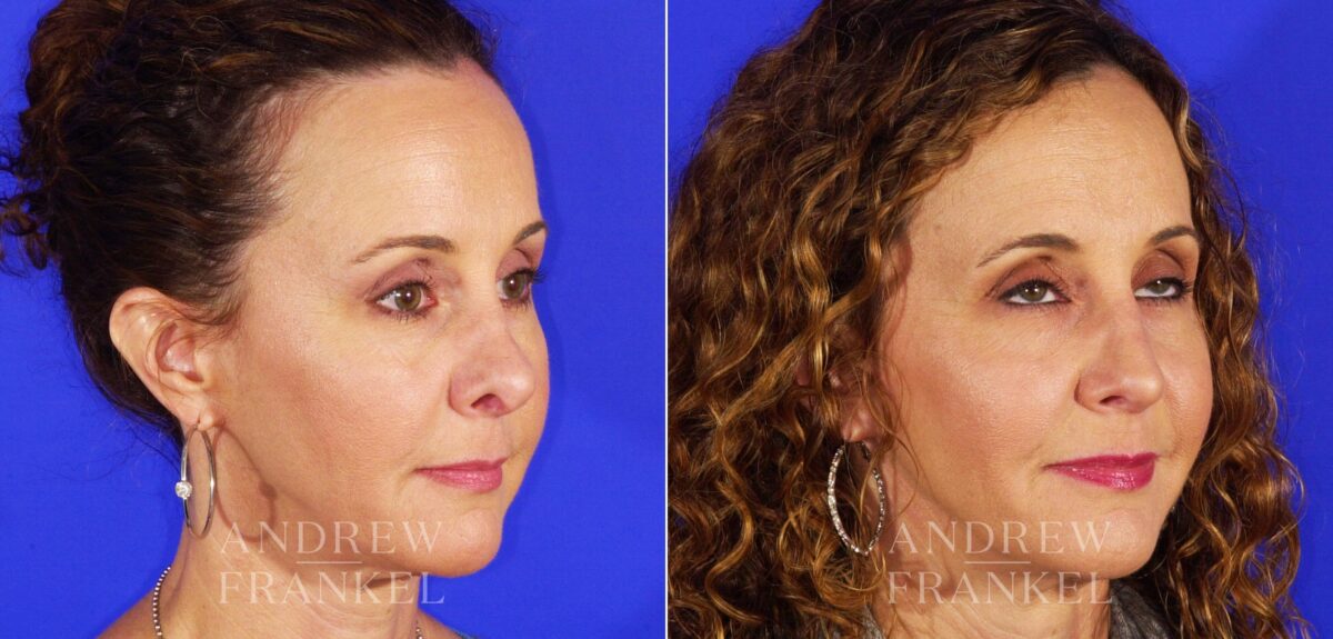 Revision Rhinoplasty before and after photos in Beverly Hills, CA, Patient 12677