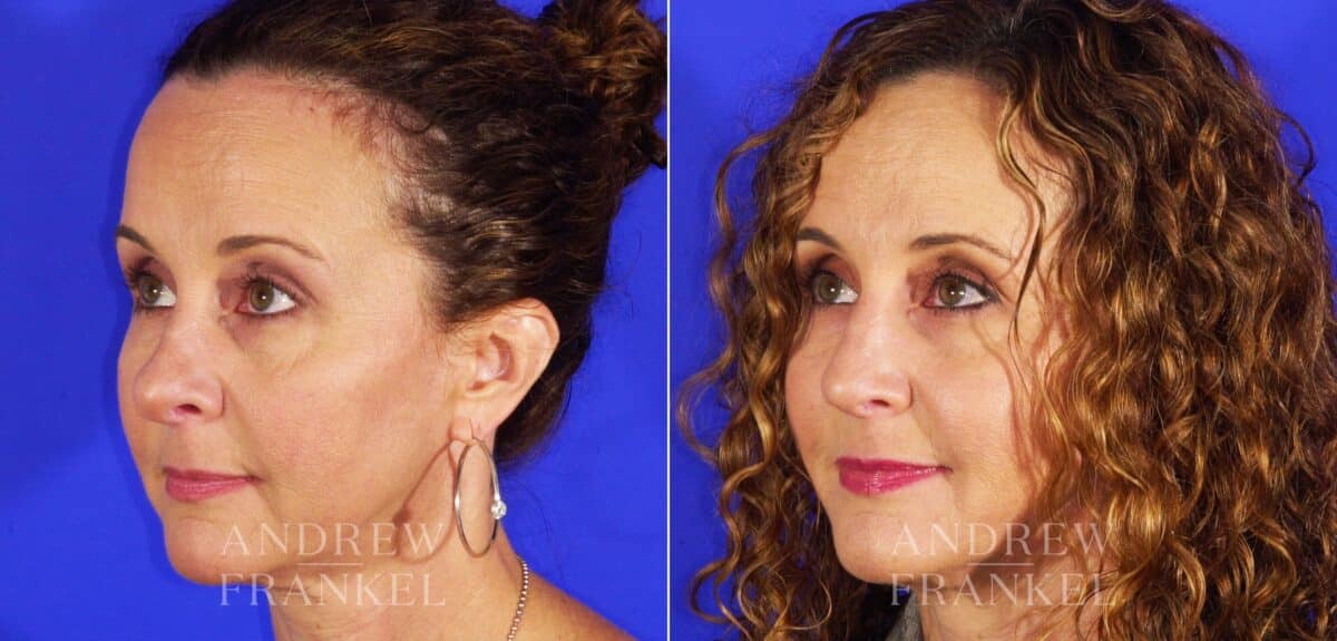 Revision Rhinoplasty before and after photos in Beverly Hills, CA, Patient 12677