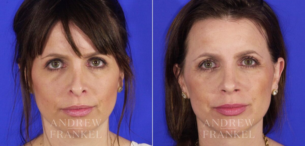 Revision Rhinoplasty before and after photos in Beverly Hills, CA, Patient 12700
