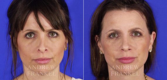 Revision Rhinoplasty before and after photos in Beverly Hills, CA, Patient 12700