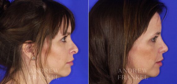 Revision Rhinoplasty before and after photos in Beverly Hills, CA, Patient 12700