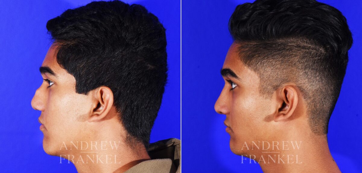 Revision Rhinoplasty before and after photos in Beverly Hills, CA, Patient 12553