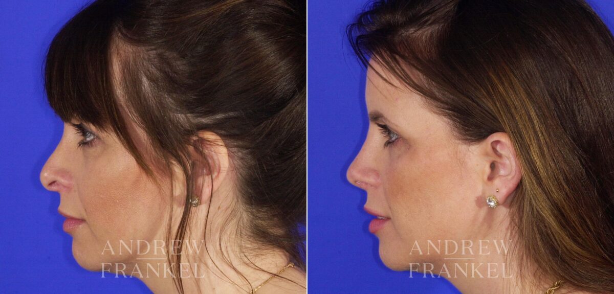 Revision Rhinoplasty before and after photos in Beverly Hills, CA, Patient 12700