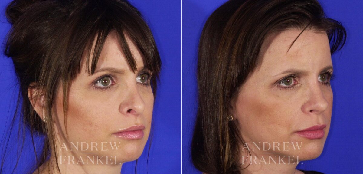 Revision Rhinoplasty before and after photos in Beverly Hills, CA, Patient 12700