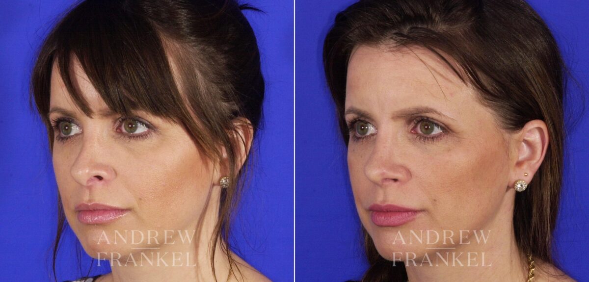 Revision Rhinoplasty before and after photos in Beverly Hills, CA, Patient 12700