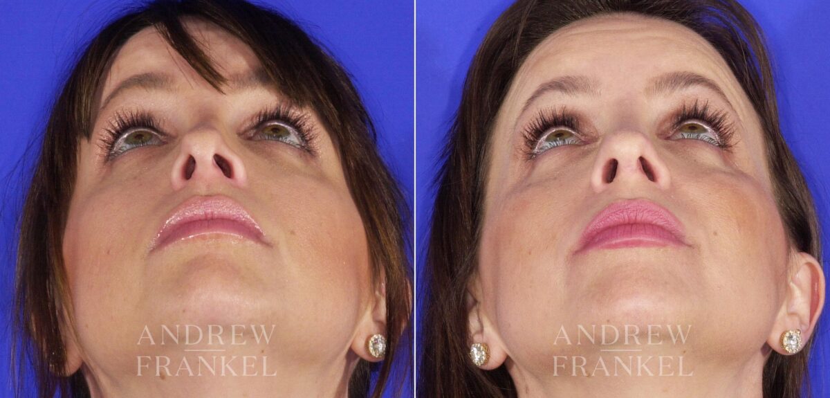 Revision Rhinoplasty before and after photos in Beverly Hills, CA, Patient 12700