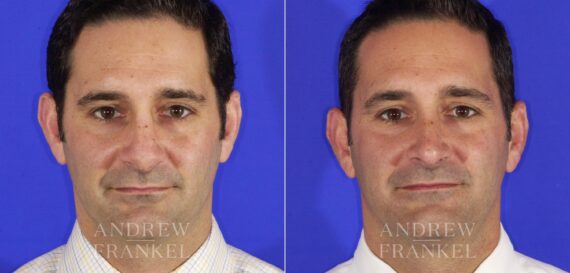 Revision Rhinoplasty before and after photos in Beverly Hills, CA, Patient 12744