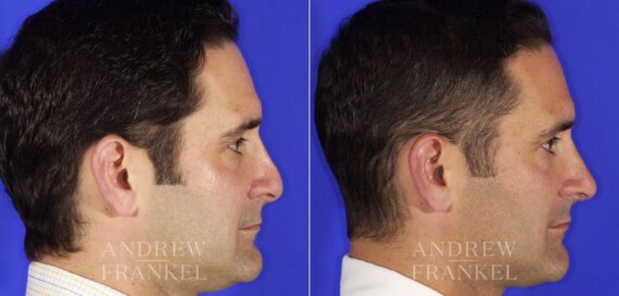 Revision Rhinoplasty before and after photos in Beverly Hills, CA, Patient 12744