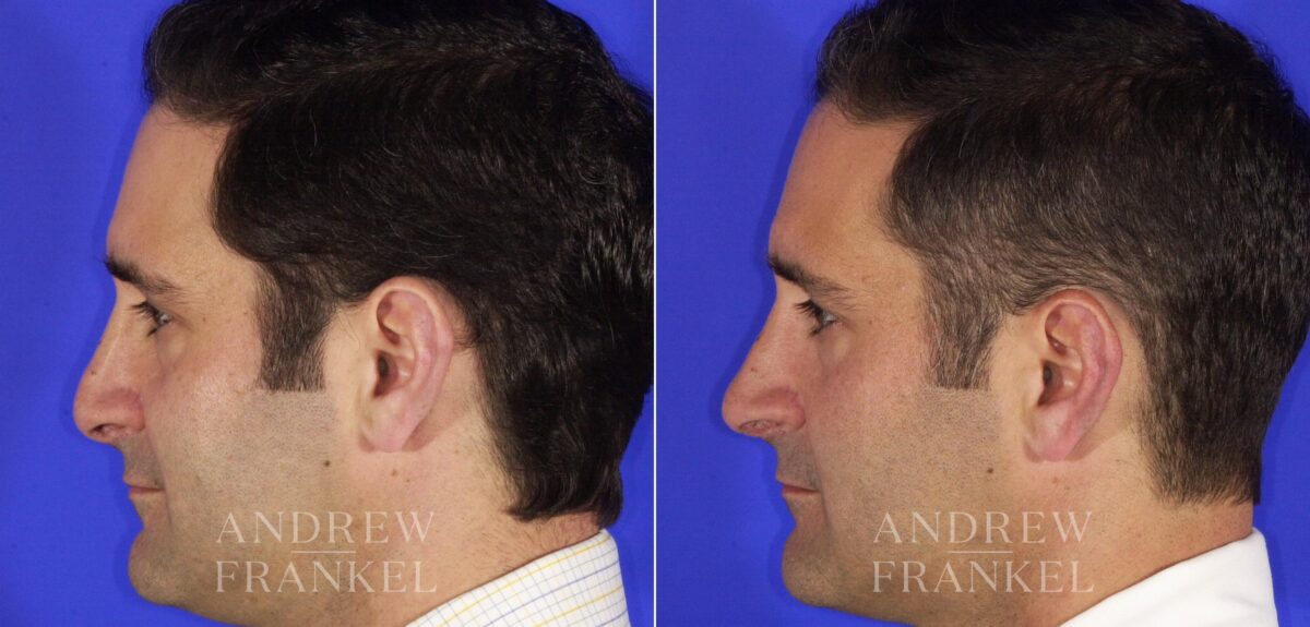 Revision Rhinoplasty before and after photos in Beverly Hills, CA, Patient 12744