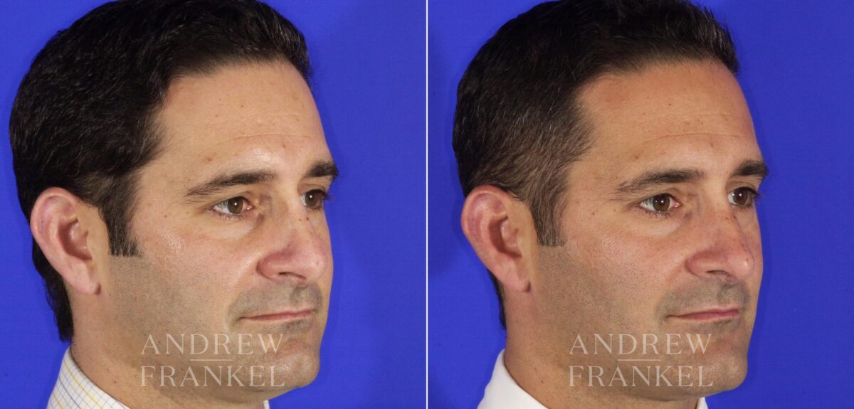 Revision Rhinoplasty before and after photos in Beverly Hills, CA, Patient 12744
