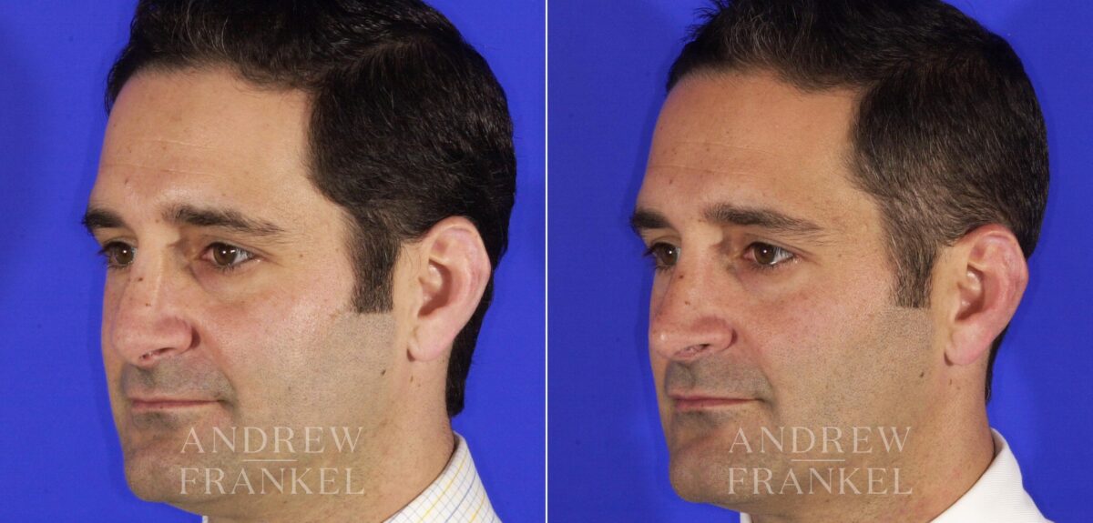 Revision Rhinoplasty before and after photos in Beverly Hills, CA, Patient 12744