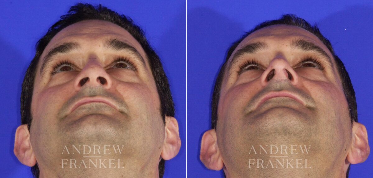 Revision Rhinoplasty before and after photos in Beverly Hills, CA, Patient 12744