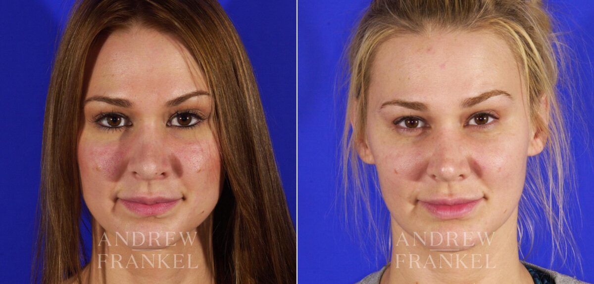 Revision Rhinoplasty before and after photos in Beverly Hills, CA, Patient 12852