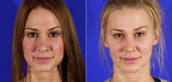 Revision Rhinoplasty before and after photos in Beverly Hills, CA, Patient 12852