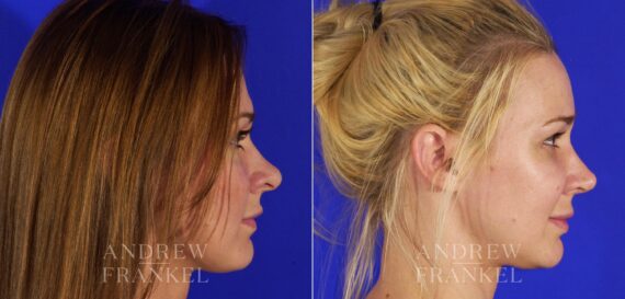 Revision Rhinoplasty before and after photos in Beverly Hills, CA, Patient 12852