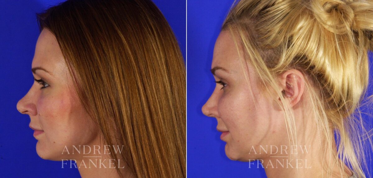 Revision Rhinoplasty before and after photos in Beverly Hills, CA, Patient 12852
