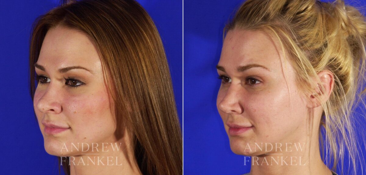 Revision Rhinoplasty before and after photos in Beverly Hills, CA, Patient 12852