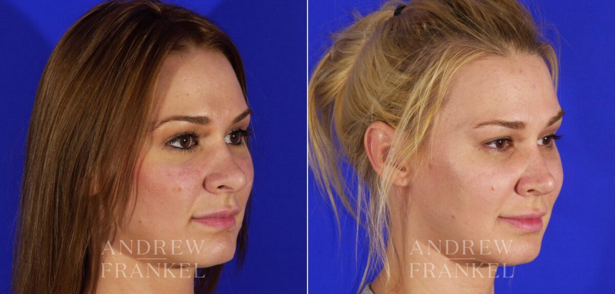 Revision Rhinoplasty before and after photos in Beverly Hills, CA, Patient 12852