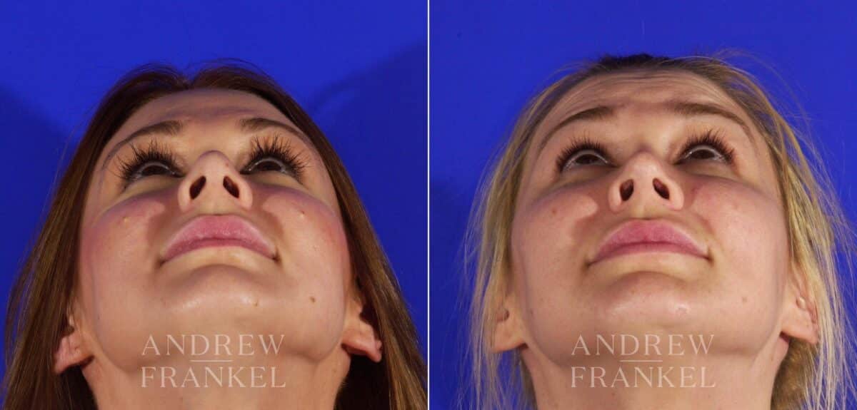 Revision Rhinoplasty before and after photos in Beverly Hills, CA, Patient 12852