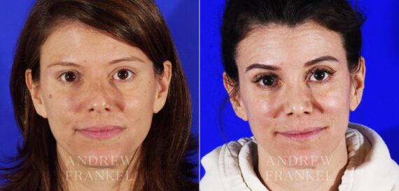 Revision Rhinoplasty before and after photos in Beverly Hills, CA, Patient 12962