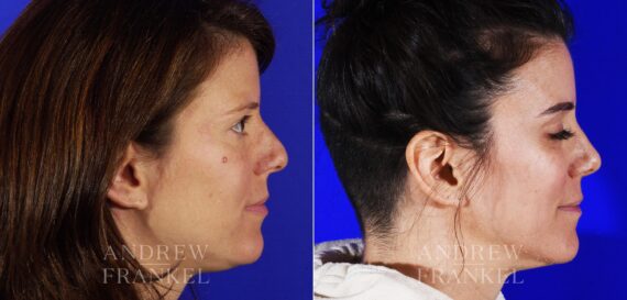 Revision Rhinoplasty before and after photos in Beverly Hills, CA, Patient 12962