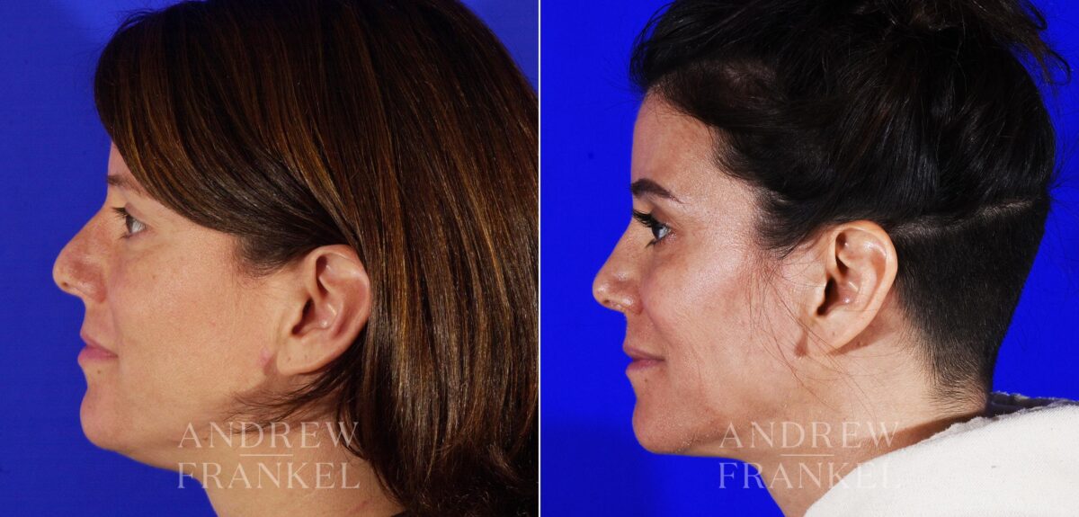Revision Rhinoplasty before and after photos in Beverly Hills, CA, Patient 12962