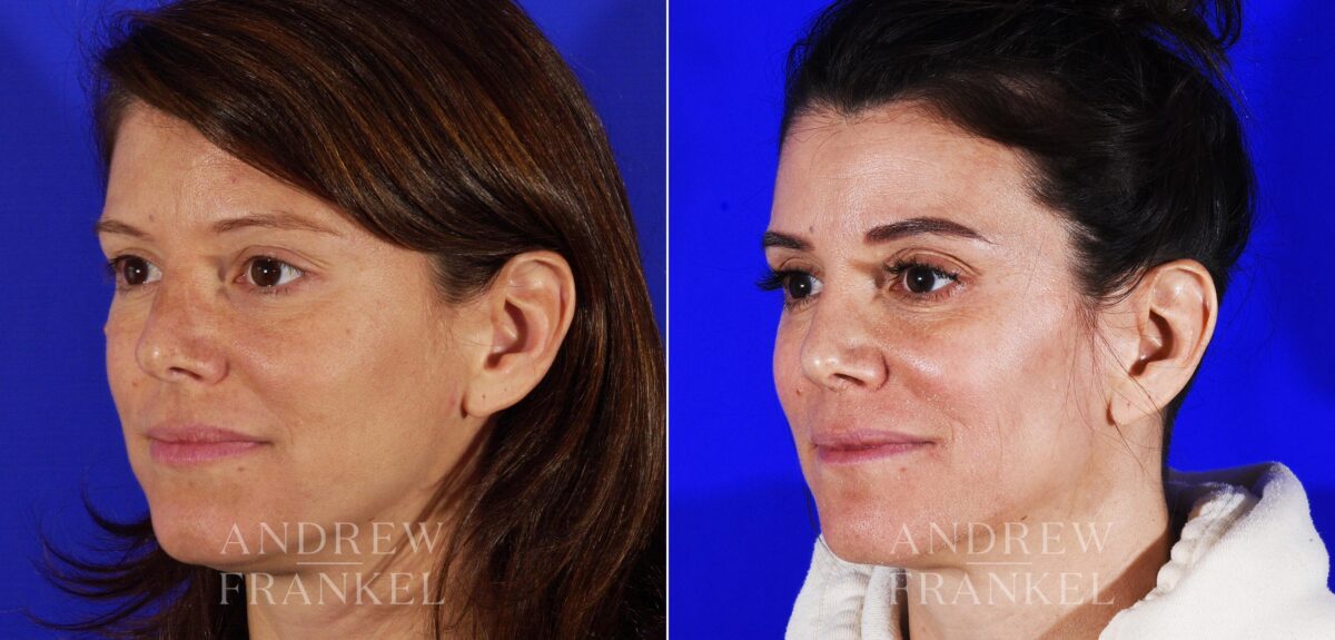 Revision Rhinoplasty before and after photos in Beverly Hills, CA, Patient 12962