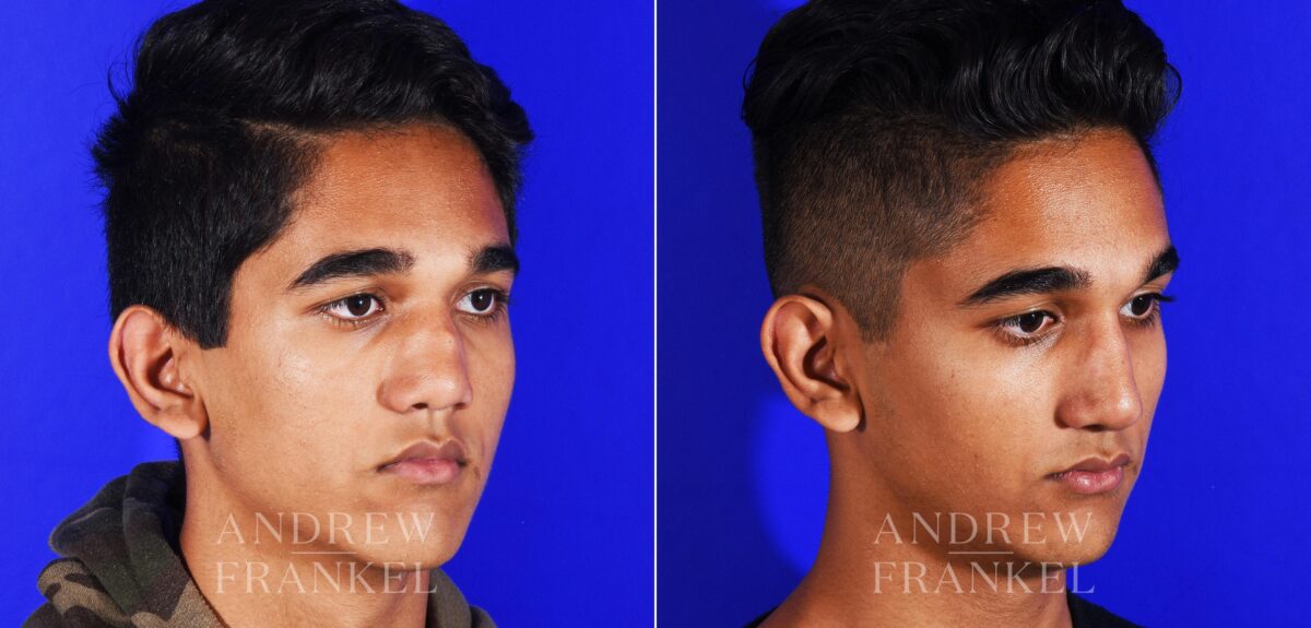 Revision Rhinoplasty before and after photos in Beverly Hills, CA, Patient 12553