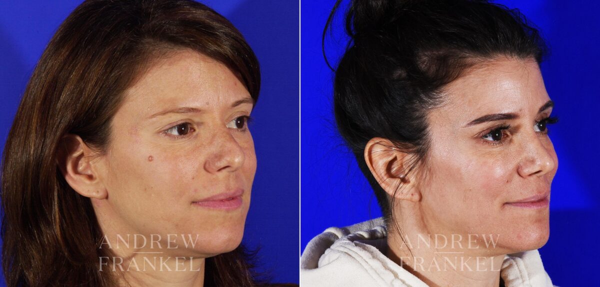 Revision Rhinoplasty before and after photos in Beverly Hills, CA, Patient 12962