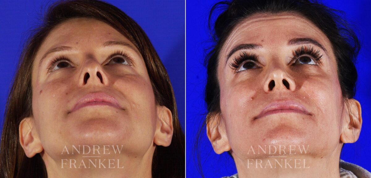 Revision Rhinoplasty before and after photos in Beverly Hills, CA, Patient 12962