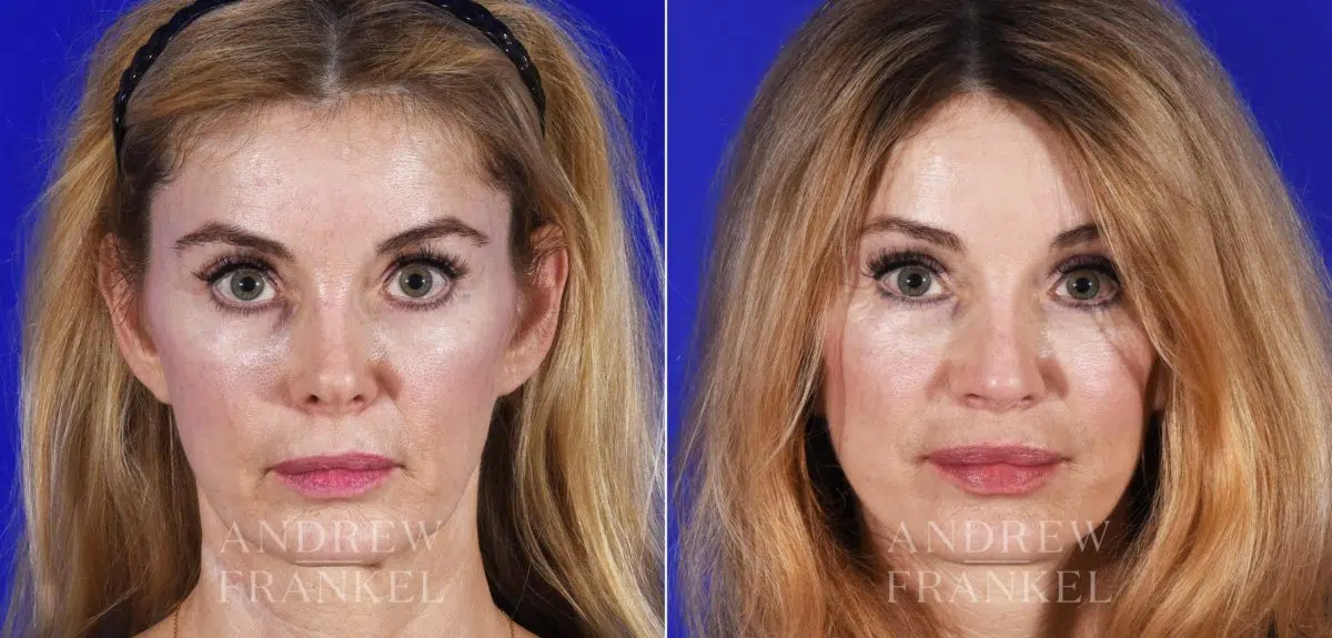 Revision Rhinoplasty before and after photos in Beverly Hills, CA, Patient 14151