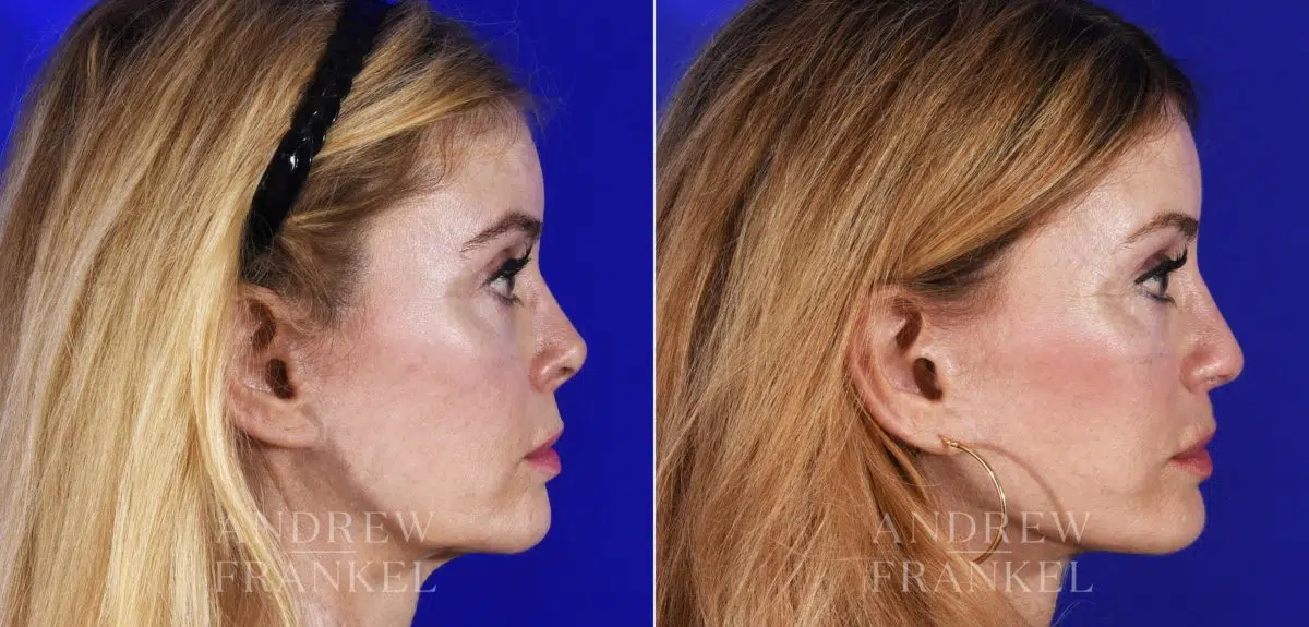 Revision Rhinoplasty before and after photos in Beverly Hills, CA, Patient 14151