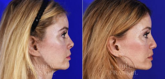 Revision Rhinoplasty before and after photos in Beverly Hills, CA, Patient 14151