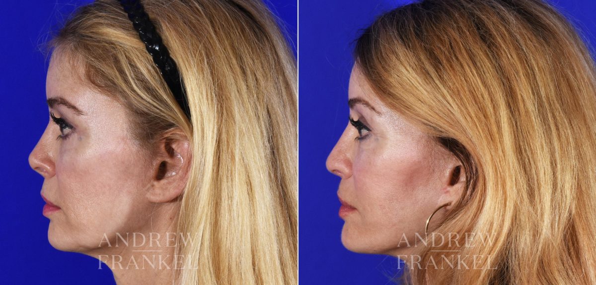Revision Rhinoplasty before and after photos in Beverly Hills, CA, Patient 14151