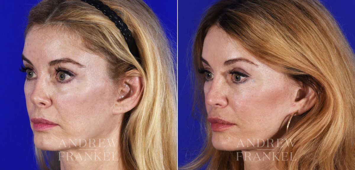 Revision Rhinoplasty before and after photos in Beverly Hills, CA, Patient 14151