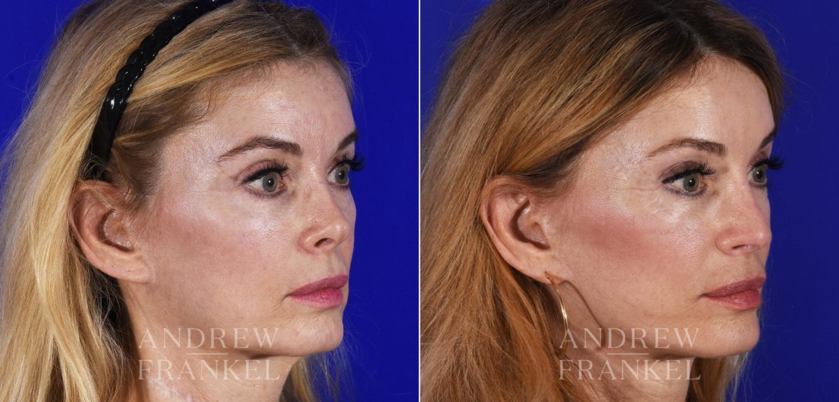 Revision Rhinoplasty before and after photos in Beverly Hills, CA, Patient 14151