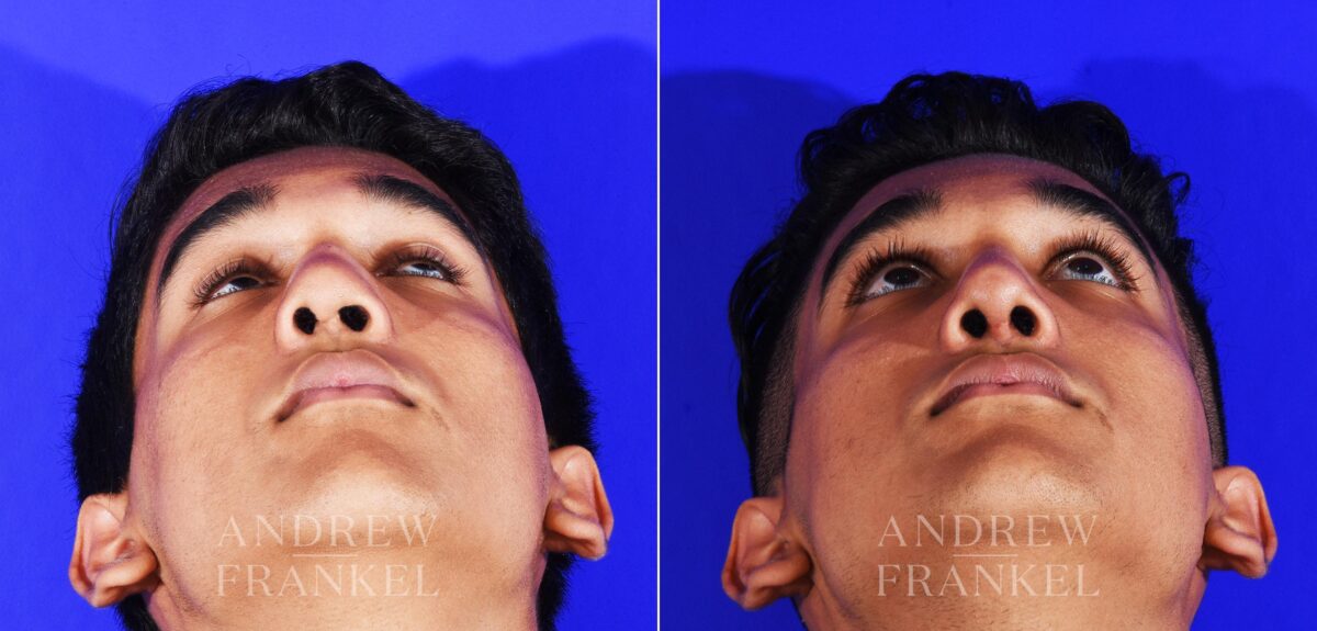 Revision Rhinoplasty before and after photos in Beverly Hills, CA, Patient 12553
