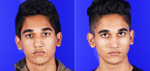Revision Rhinoplasty before and after photos in Beverly Hills, CA, Patient 12553