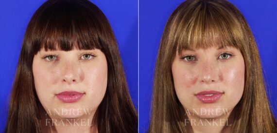 Revision Rhinoplasty before and after photos in Beverly Hills, CA, Patient 12611
