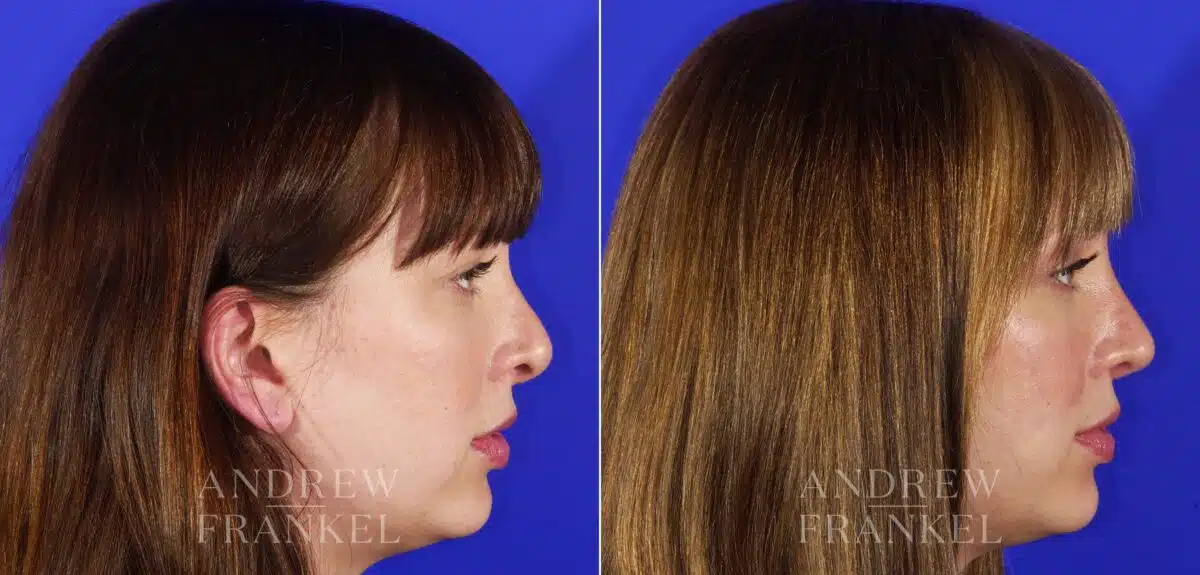 Revision Rhinoplasty before and after photos in Beverly Hills, CA, Patient 12611