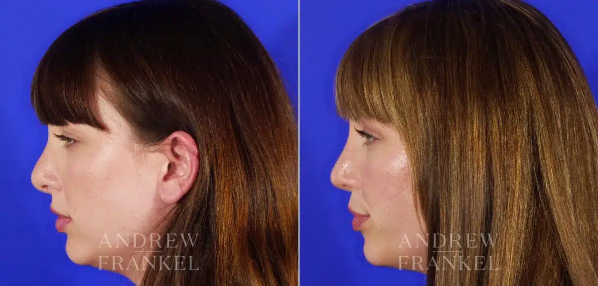 Revision Rhinoplasty before and after photos in Beverly Hills, CA, Patient 12611